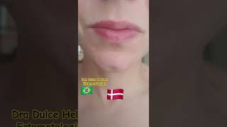 Queilite esfoliativa antes e depois Exfoliative cheilitis before and after [upl. by Essirahs]