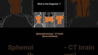 Sphenoid sinuses  CT brain  bone windows CT Brain Anatomy Sinuses Quiz 8radiologychannel007 [upl. by Champaigne]