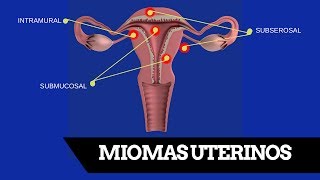 Como Eliminar Miomas Sin Histerectomía [upl. by Meghan]