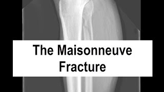 The Maisonneuve Fracture [upl. by Ahtinak]