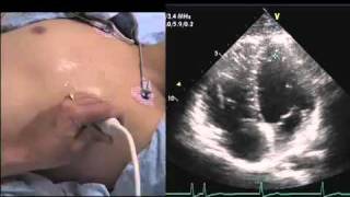 Intro to Echo Apical 4 Chamber Viewmov [upl. by Eronel500]