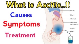 causes of ascites fluid in abdomen  treatment of ascites due to liver cirrhosis  ascites fluid [upl. by Cloots]