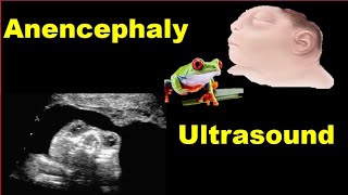 Anencephaly Ultrasound [upl. by Zebulen]