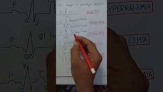 ECG changes in electrolyte imbalance Hypokalemia Hyperkalemiahypocalcemia Hypercalcemia shorts [upl. by Elberta]