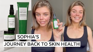 Sophias journey back to skin health [upl. by Sillihp]