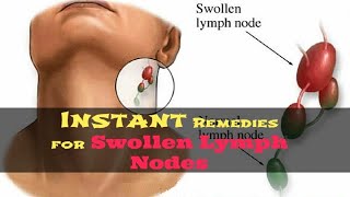 How to Get Rid of Swollen Lymph Nodes Naturally  5 Remedies for Swollen Lymph Nodes in Neck [upl. by Alithea]