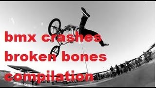 BMX crashes broken bones compilation [upl. by Dupuis]