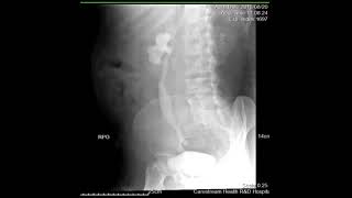 CASE REVIEW intravenous pyelography IVP [upl. by Amary689]