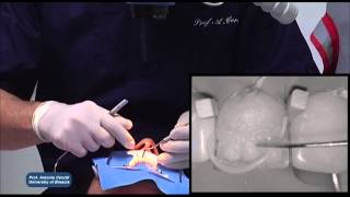 IPS Empress Direct StepbyStep with Prof Antonio Cerutti [upl. by Jermaine]