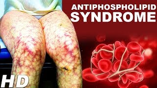 Antiphospholipid Antibody Syndrome An Autoimmune Disease  Antiphospholipid Treatments And Symptoms [upl. by Warchaw544]