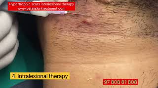 Hypertrophic scar treatment by intralesional therapy Dr Sandeep Gupta BALAJI SKIN CLINIC Hari Nagar [upl. by Orlan]