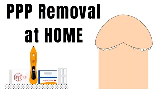 Pearly Penile Papules treatment at home  PPP removal with PPP KIT [upl. by Butta]