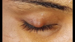 Chalazion Incision amp Curettage HD [upl. by Ainelec]