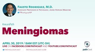 Meningiomas  Dr Rodriguez Hopkins NEUROPATH [upl. by Aimahs]