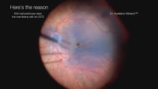 Patient with mild and thin epiretinal membrane with 2020 vision but complained of distortion [upl. by Aruon]