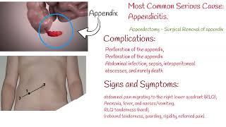 Pain in Lower Right Abdomen  causes and symptoms [upl. by Kauffman765]