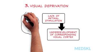 Ophthalmology – Amblyopia By Christine Law MD [upl. by Einnij]