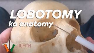 Lobotomy ka Anatomy in Hindi [upl. by Maro650]