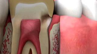 Crowns Margin Decay Diagnosis [upl. by Mattox]