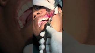 Special instrument and technique for upper 3rd molar surgery7044611705 thirdmolarsurgery [upl. by Mannuela]