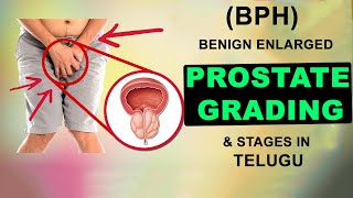 Benign Enlarged Prostate BPH Grading and Stages in Telugu i STAGE 1 I STAGE 2 I STAGE 3 I [upl. by Flita]