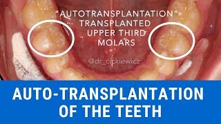 How to autotransplant the human teeth [upl. by Arihsay]