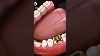 Souriez sans crainte  Tout ce que vous devez savoir sur lélimination des caries dentaires [upl. by Lukash619]