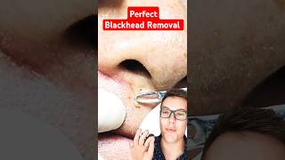 OMG Next Level BLACKHEAD REMOVAL shorts [upl. by Achorn]