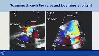 Echo Assessment of Aortic Valve Prosthesis Regurgitation [upl. by Iduj]