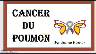 Cancer du Poumon Cancer Bronchique  Symptômes Causes Traitement Dépistage Biopsie Stades TNM 3minut [upl. by Negrom94]