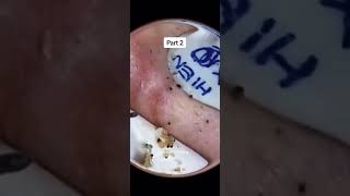 Blackheads Removal  Acne Treatment and Very Satisfying Satisfying Pimple pop blackheads [upl. by Leinadnhoj]