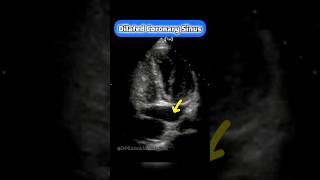 Coronary Sinus on Echocardiography echocardiogram cardiology echo [upl. by Nedyarb852]