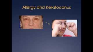 Ocular Allergy and Keratoconus [upl. by Eidnarb62]