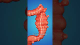 Como a Diverticulite afeta o intestino shorts curiosidades medicina [upl. by Walsh445]