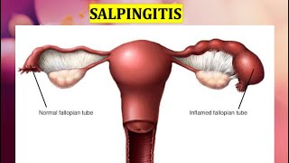 SALPINGITISAcuteChronic HydrosalpinxPyosalpinxChronic InterstitialSalpingitis isthamic nodosa [upl. by Fagan466]