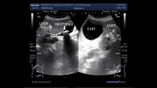 Ultrasound Video showing the Differentiation between Simple Hepatic Cyst and Hydatid Cyst [upl. by Tnomed851]