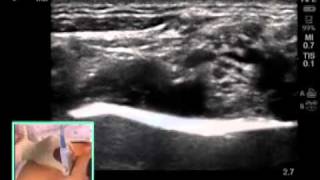 ULTRASOUNDGUIDED SUPRACLAVICULAR NERVE BLOCK [upl. by Assyla]