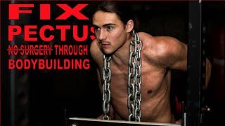 FIX PECTUS EXCAVATUM THROUGH BODYBUILDING [upl. by Mastat]