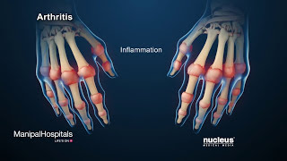 How Is Rheumatoid Arthritis Treated  Symptoms Of Rheumatoid Arthritis  Manipal Hospitals [upl. by Rbma]