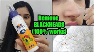 HOW TO REMOVE BLACKHEADS PERMANENTLY  EASY AND PAINLESS METHOD [upl. by Myrna]