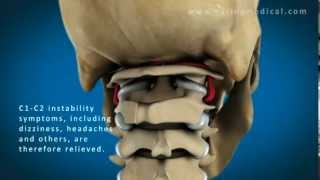 C1 and C2 Atlantoaxial Instability Upper Cervical Instability and Prolotherapy animation [upl. by Emse]