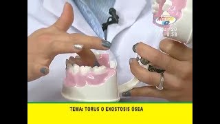 ¿Qué es el torus o exostosis ósea [upl. by Tana]