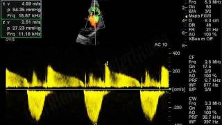 Stenosi polmonare canePulmonic stenosisCardiologia Veterinariaeuwmv [upl. by Naneik265]