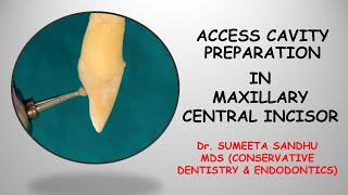 Incisor access opening Incisor access cavity RCT Easy endodontics for maxillary incisor [upl. by Wind566]