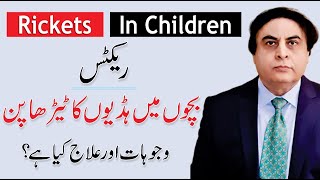 Rickets Disease  Causes amp Treatment  Rickets In Children  By Dr Khalid Jamil [upl. by Ittam]