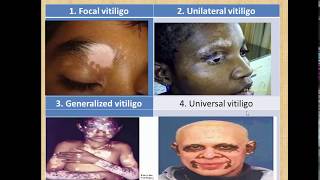 دكتور محمود سويلم شرح الجلدية 2018 vitilgo acne alopecia dermatological Disorders [upl. by Coffin]