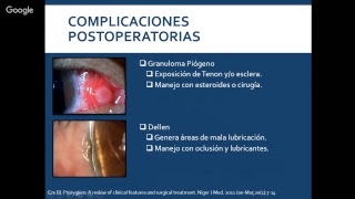 ENFERMEDADES DEGENERATIVAS PINGUECULA Y PTERIGION [upl. by Eeloj]