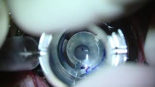 Manual Intacs Implantation for Keratoconus [upl. by Notrab831]