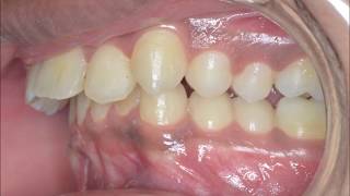 Braces time lapseoverbite and overjet correction braces before after [upl. by Diandra]