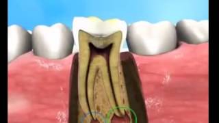 Treatment for Periapical abscess [upl. by Akirdnwahs]